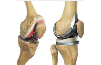 Knee Replacement Surgery Cost in Anna Nagar