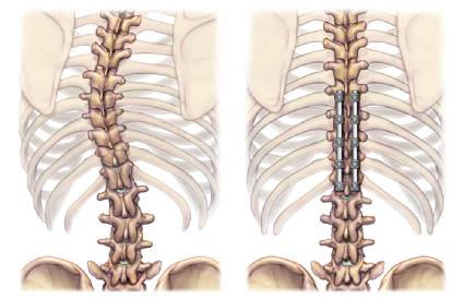 Scoliosis Correction Surgery in Anna Nagar